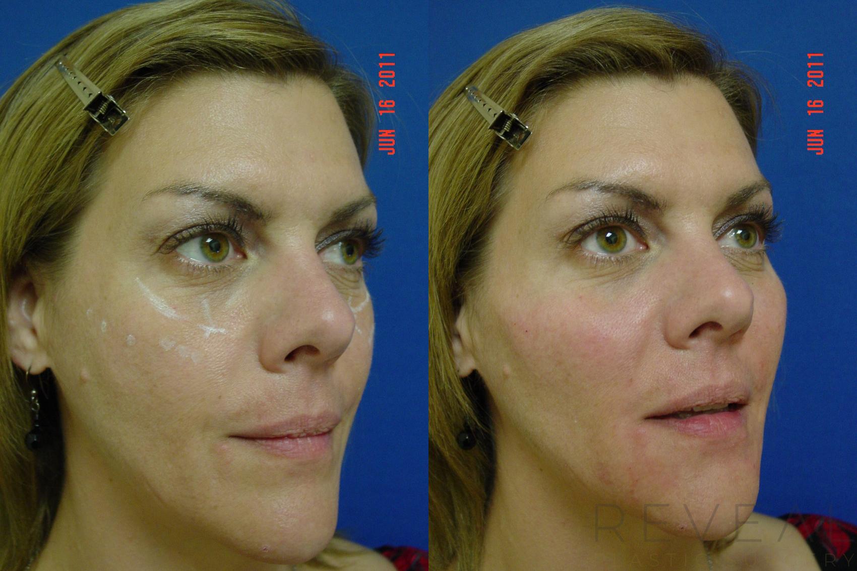 Before & After Injectable Fillers Case 73 View #3 View in San Jose, CA