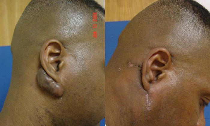 Before & After Keloid Scar Revision Case 7 View #1 View in San Jose, CA