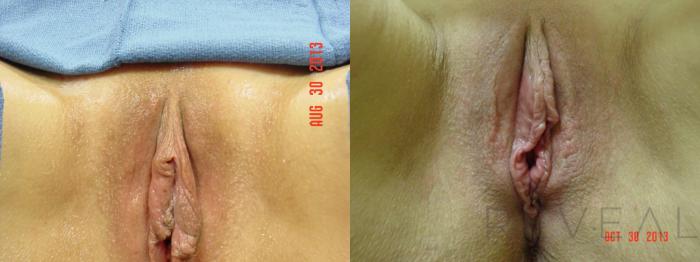 Before & After Labiaplasty Case 116 View #1 View in San Jose, CA