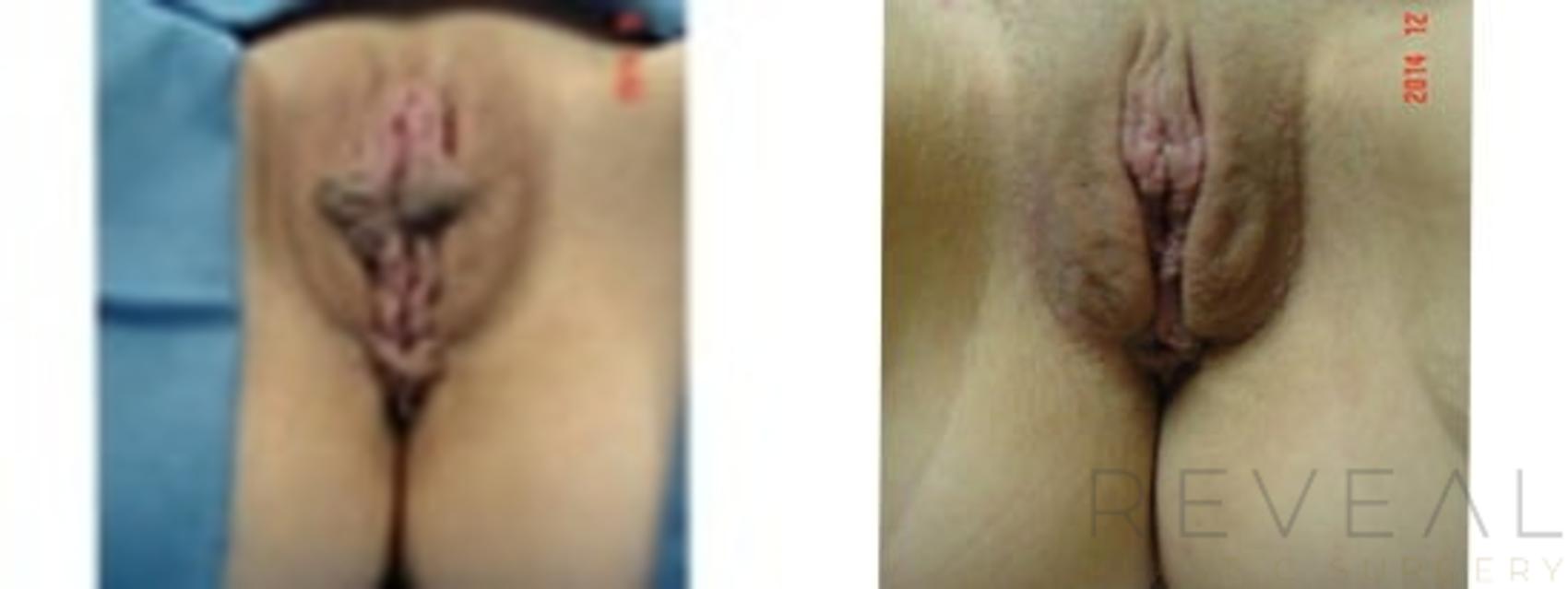 Before & After Labiaplasty Case 165 View #1 View in San Jose, CA