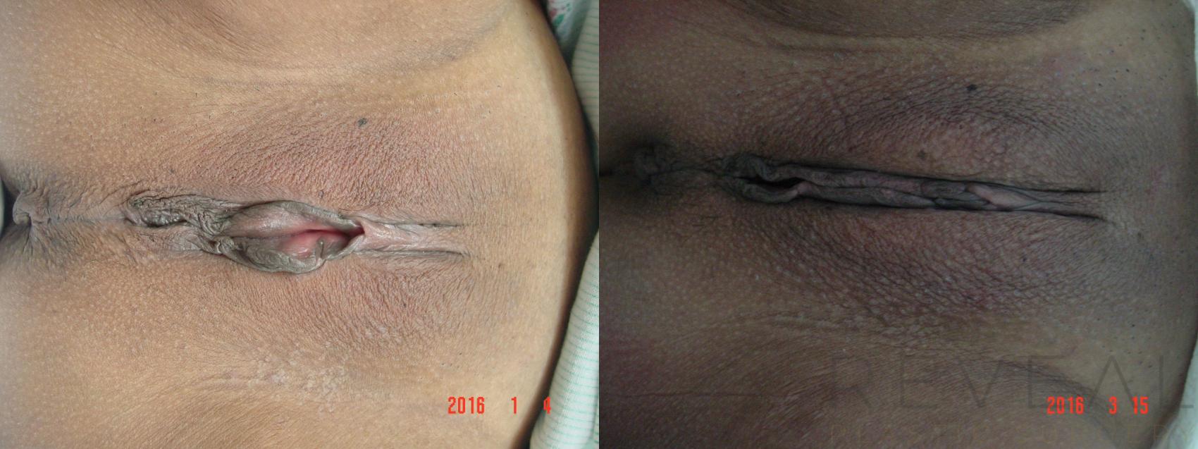 Before & After Labiaplasty Case 186 View #1 View in San Jose, CA