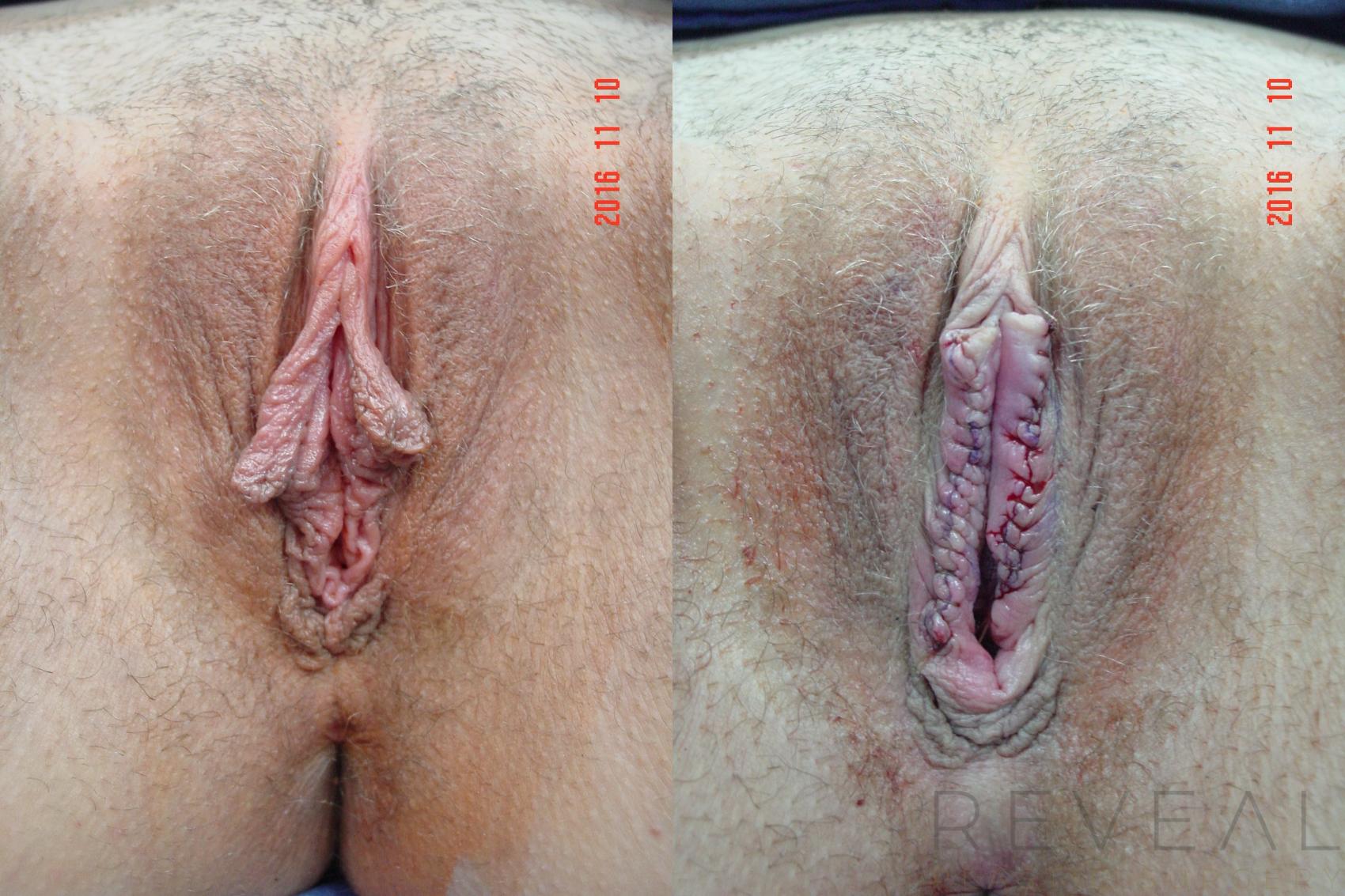 Before & After Labiaplasty Case 206 View #1 View in San Jose, CA