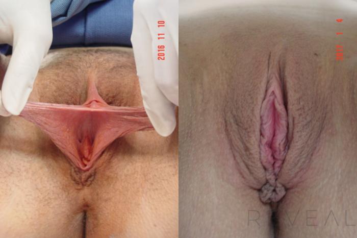Before & After Labiaplasty Case 206 View #3 View in San Jose, CA