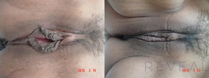 Before & After Labiaplasty Case 327 View #1 View in San Jose, CA