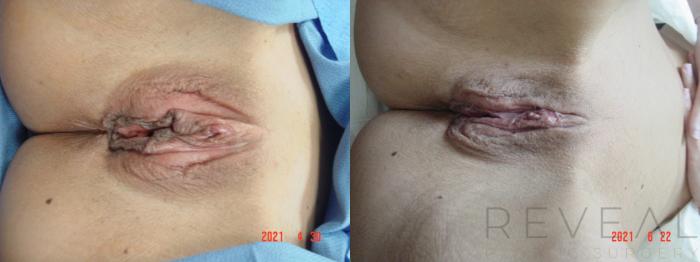 Before & After Labiaplasty Case 569 View #1 View in San Jose, CA
