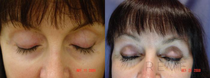 Before & After LATISSE® Eyelash Enhancement Case 9 View #1 View in San Jose, CA