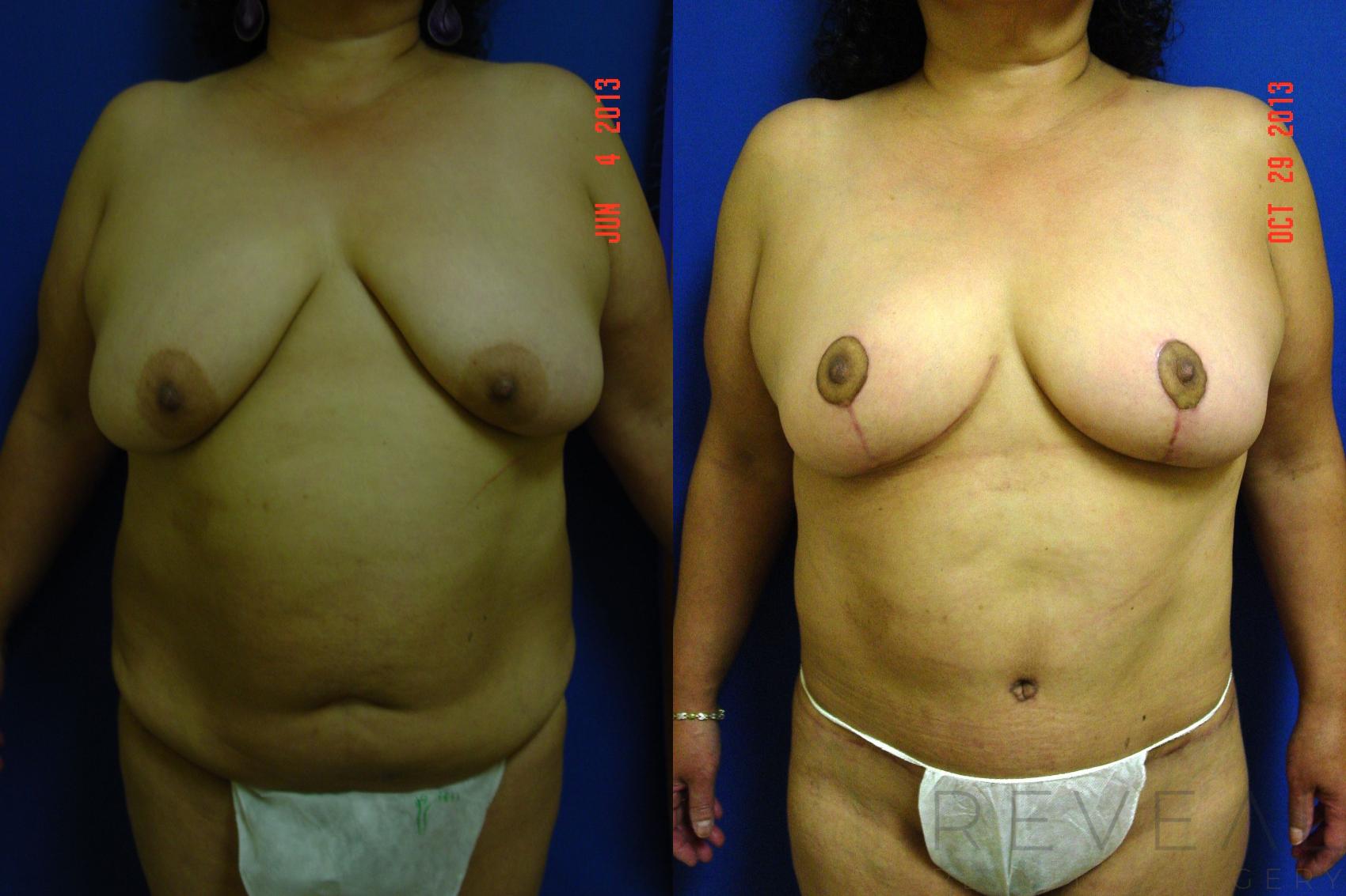 Before & After Breast Lift Case 118 View #1 View in San Jose, CA