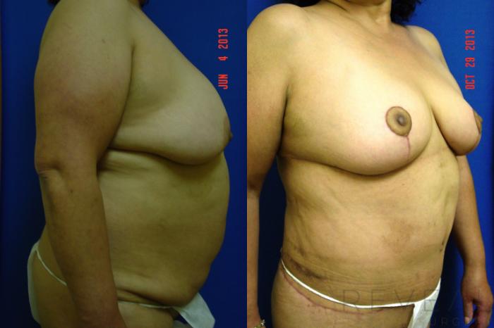 Before & After Breast Lift Case 118 View #2 View in San Jose, CA