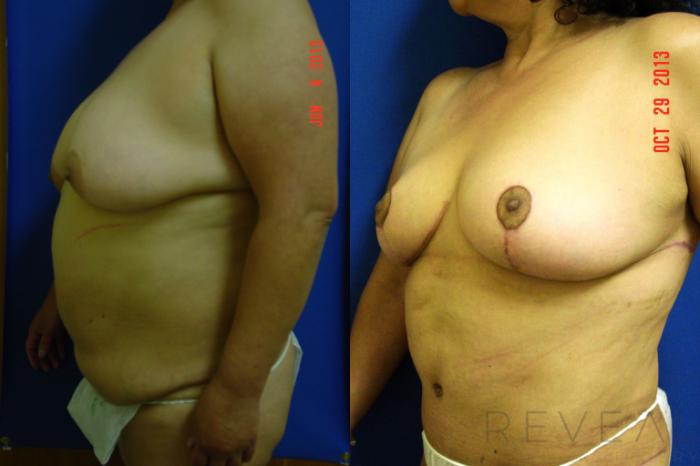 Before & After Tummy Tuck Case 118 View #3 View in San Jose, CA