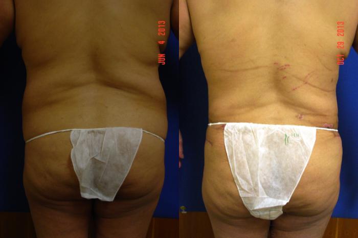 Before & After Liposuction Case 118 View #4 View in San Jose, CA