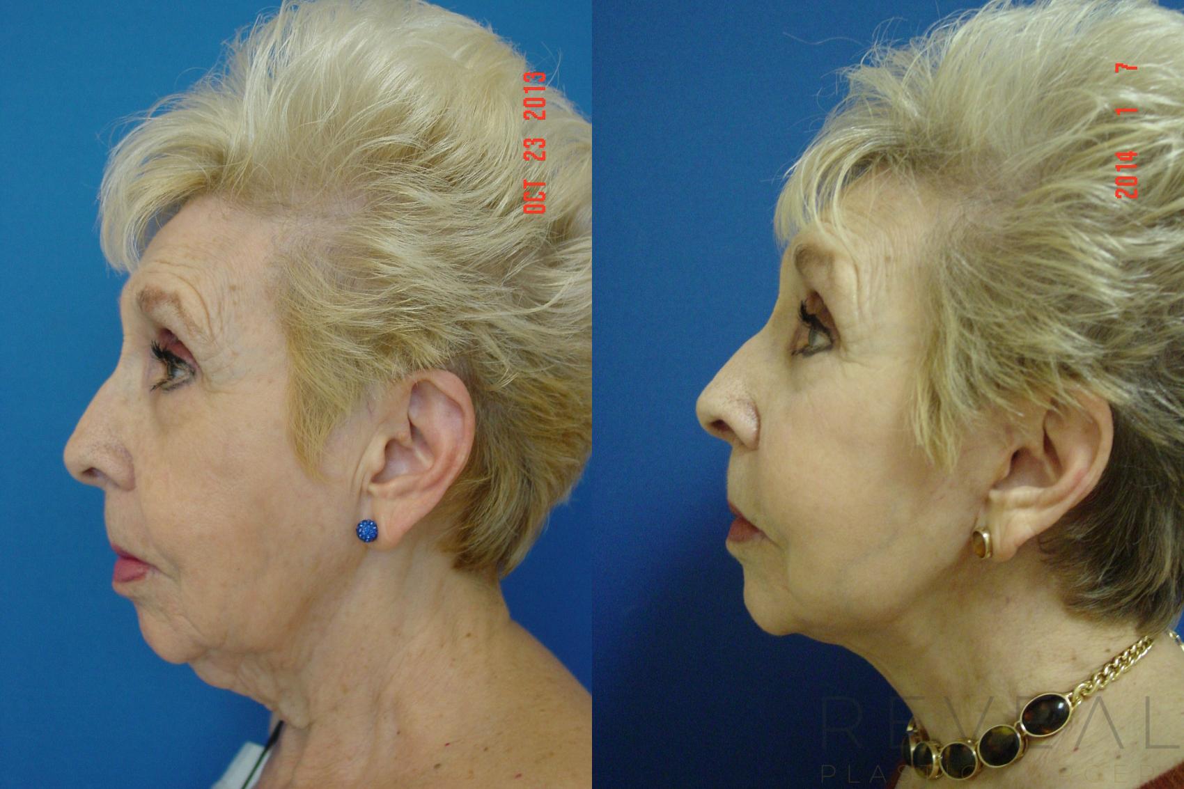 Before & After Facelift Case 124 View #1 View in San Jose, CA