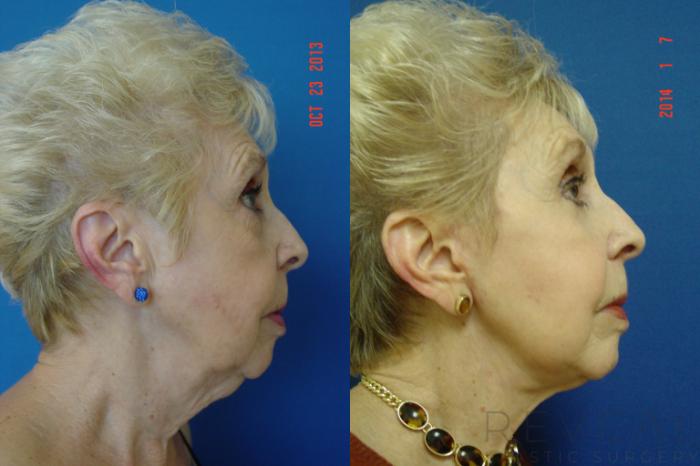 Before & After Eyelid Surgery Case 124 View #2 View in San Jose, CA