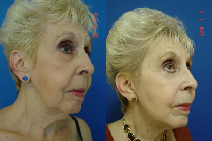 Before & After Facelift Case 124 View #4 View in San Jose, CA