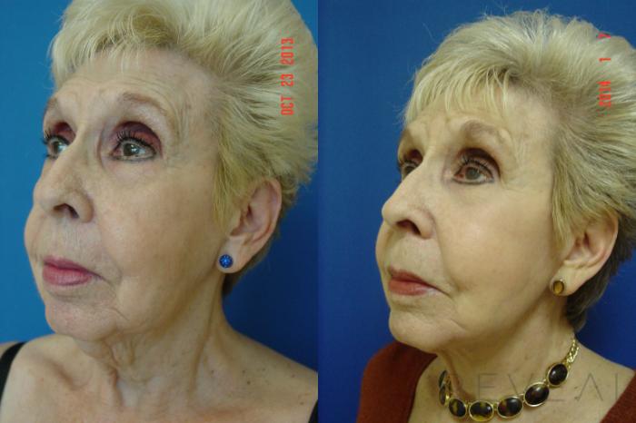 Before & After Facelift Case 124 View #5 View in San Jose, CA