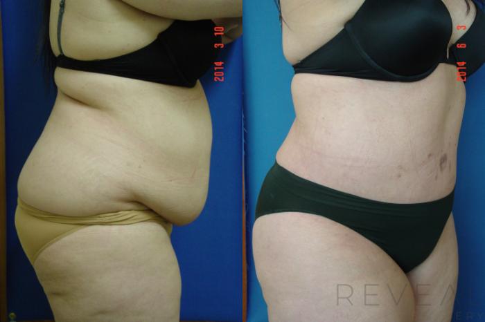 Before & After Liposuction Case 141 View #1 View in San Jose, CA