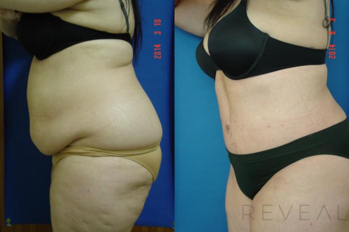 Before & After Liposuction Case 141 View #2 View in San Jose, CA