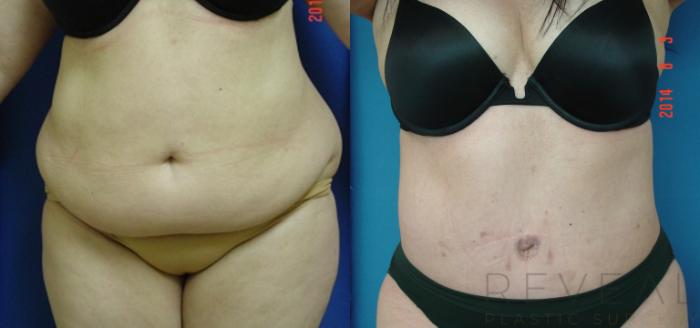 Before & After Tummy Tuck Case 141 View #3 View in San Jose, CA