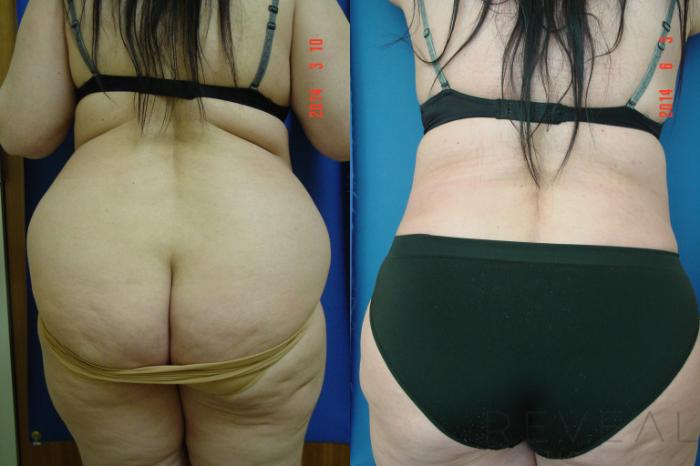 Before & After Tummy Tuck Case 141 View #4 View in San Jose, CA