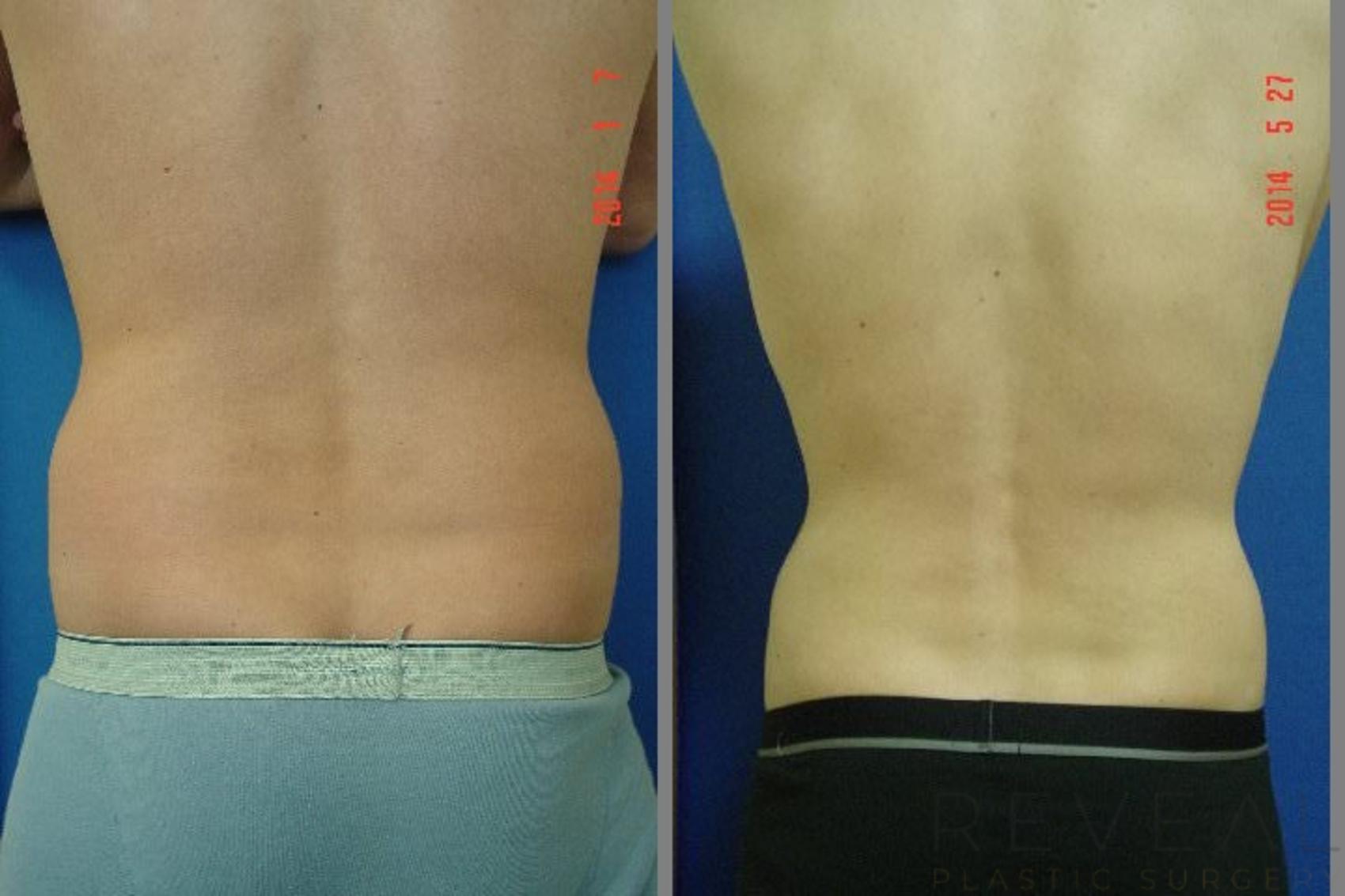 Before & After Liposuction Case 142 View #1 View in San Jose, CA