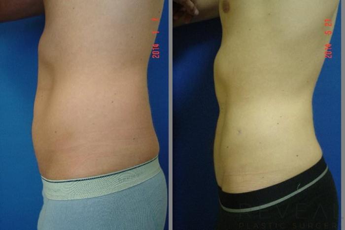 Before & After Liposuction Case 142 View #2 View in San Jose, CA