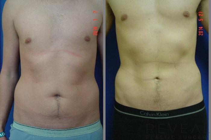Before & After Liposuction Case 142 View #3 View in San Jose, CA