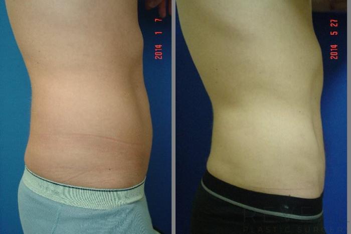 Before & After Liposuction Case 142 View #4 View in San Jose, CA