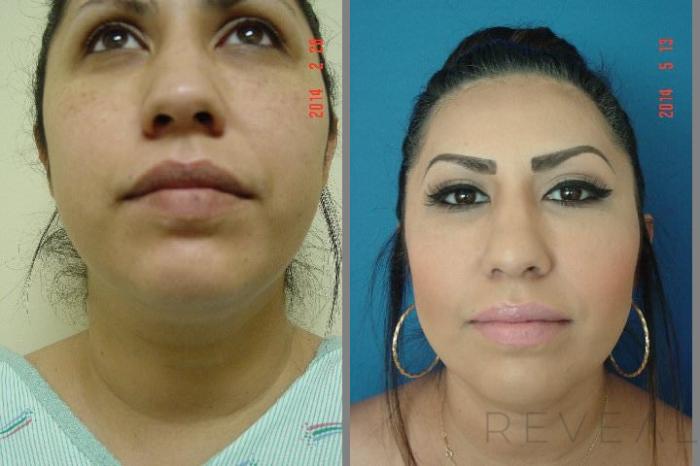 Before & After Liposuction Case 145 View #1 View in San Jose, CA