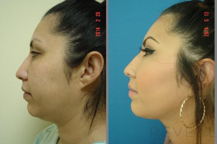 Before & After Liposuction Case 145 View #2 View in San Jose, CA