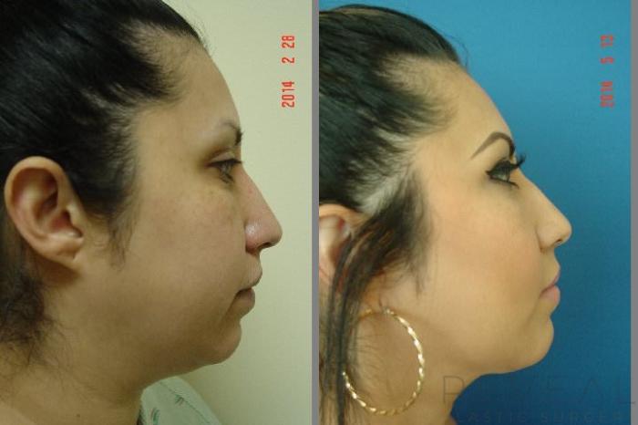 Before & After Liposuction Case 145 View #3 View in San Jose, CA