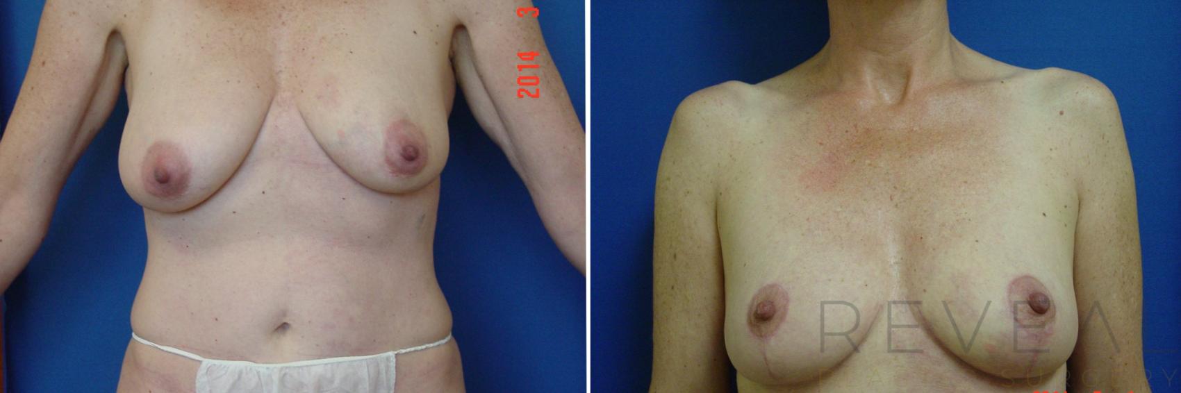 Before & After Liposuction Case 150 View #1 View in San Jose, CA