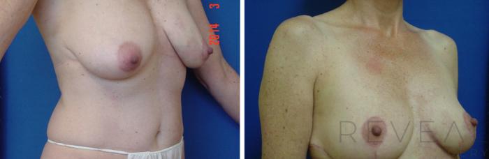 Before & After Liposuction Case 150 View #2 View in San Jose, CA
