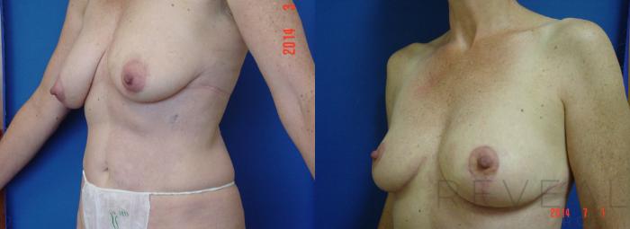 Before & After Breast Reduction Case 150 View #3 View in San Jose, CA