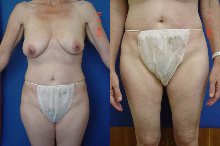 Before & After Liposuction Case 150 View #4 View in San Jose, CA