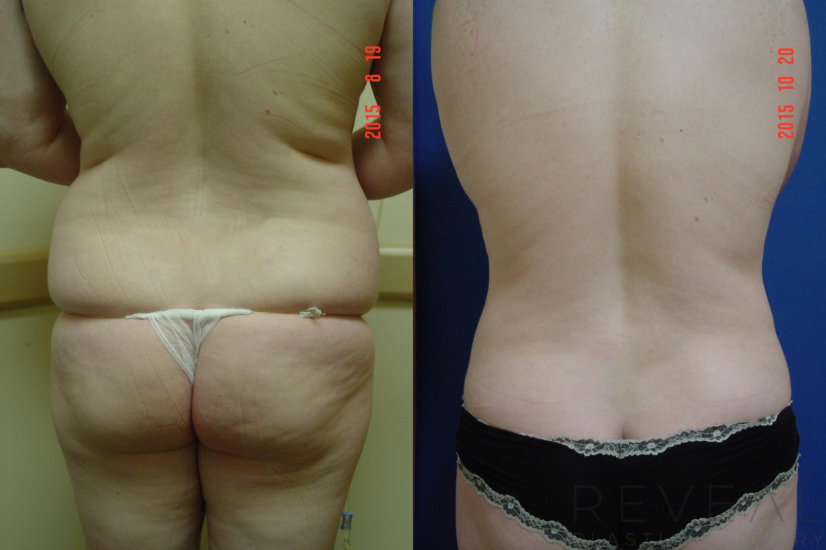 Before & After Liposuction Case 183 View #1 View in San Jose, CA