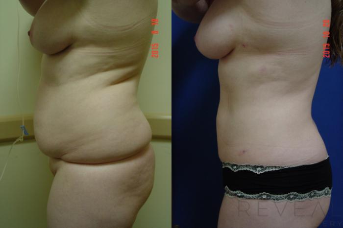 Before & After Liposuction Case 183 View #3 View in San Jose, CA