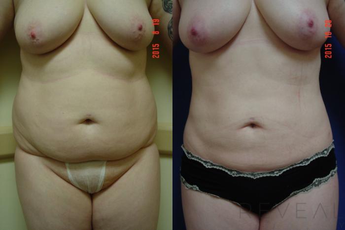 Before & After Liposuction Case 183 View #4 View in San Jose, CA
