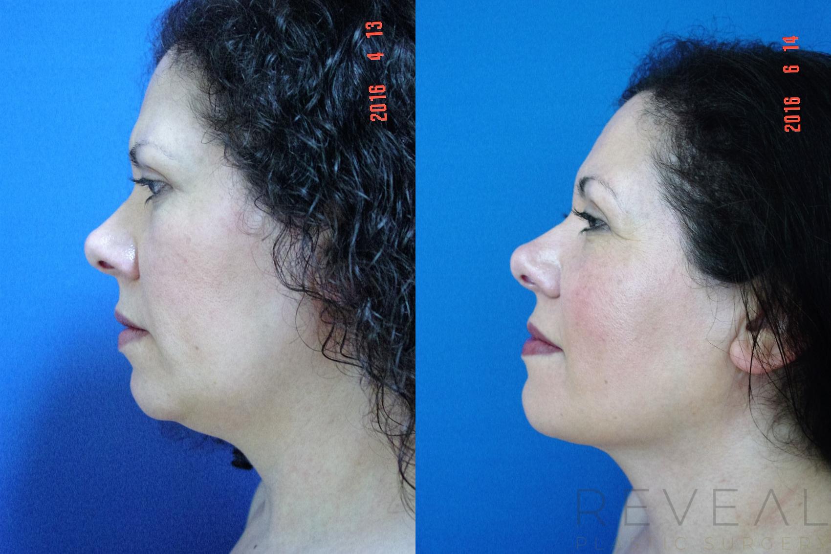 Before & After Liposuction Case 193 View #1 View in San Jose, CA