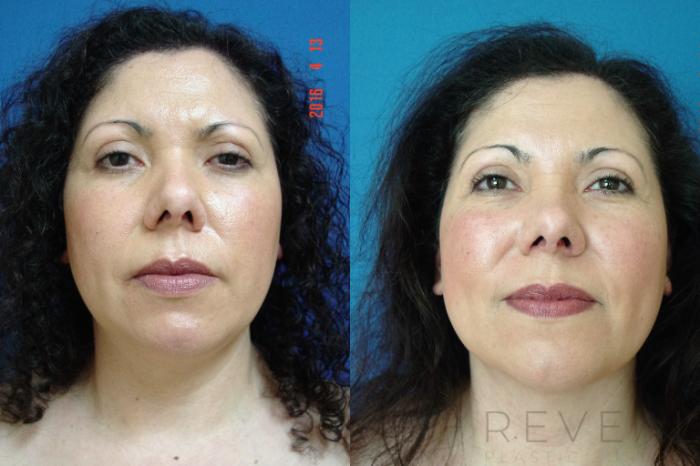 Before & After Liposuction Case 193 View #2 View in San Jose, CA
