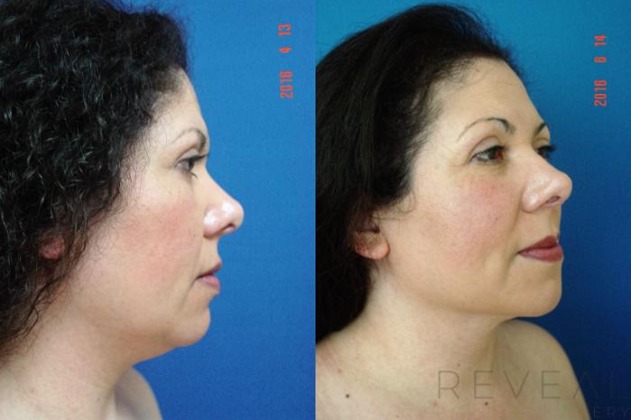Before & After Liposuction Case 193 View #3 View in San Jose, CA