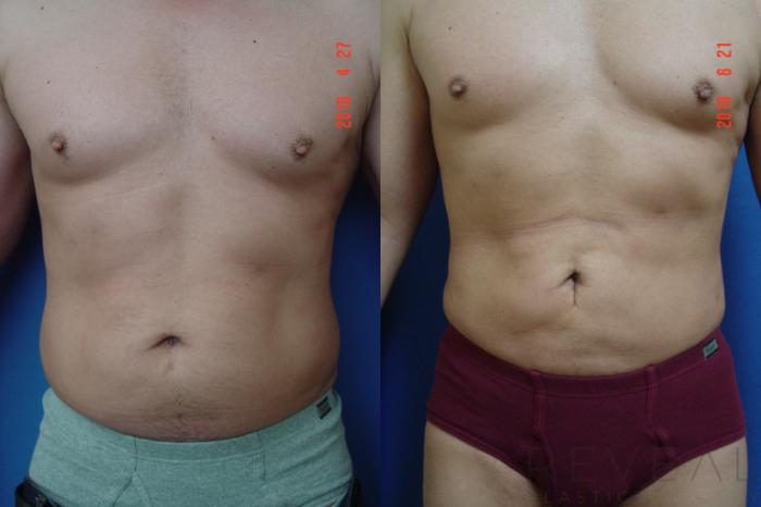 Before & After Liposuction Case 194 View #1 View in San Jose, CA