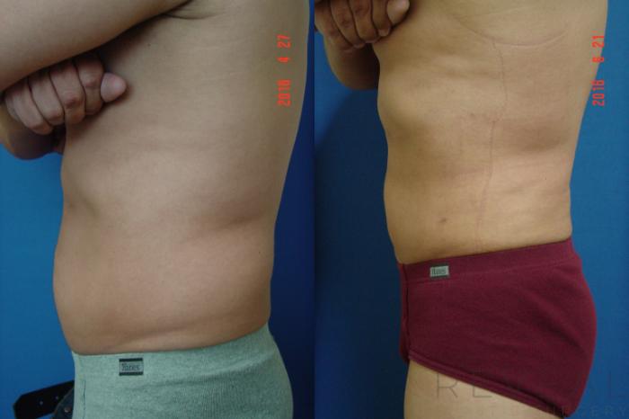 Before & After Liposuction Case 194 View #2 View in San Jose, CA