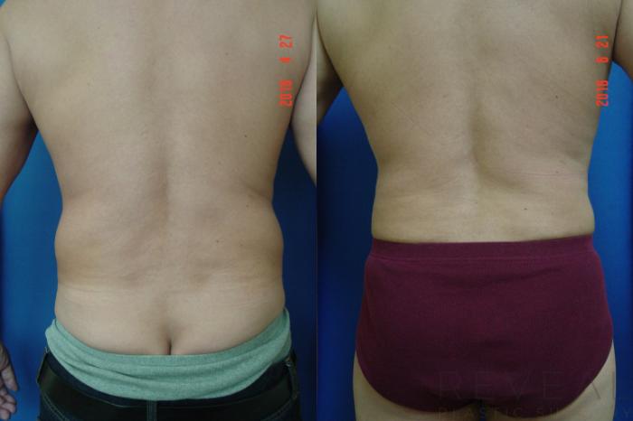 Before & After Liposuction Case 194 View #3 View in San Jose, CA