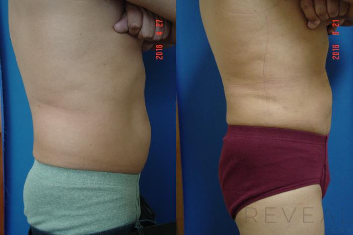 Before & After Liposuction Case 194 View #4 View in San Jose, CA