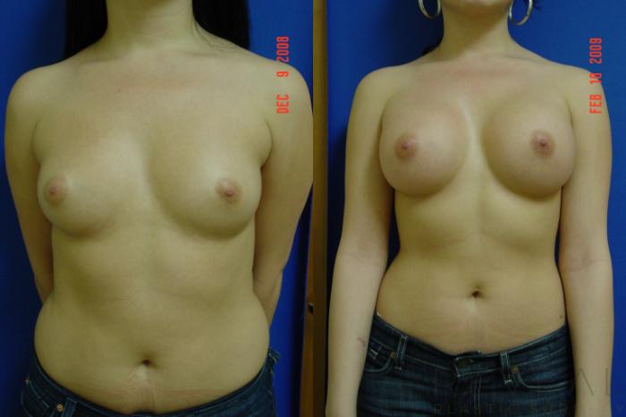 Before & After Liposuction Case 20 View #1 View in San Jose, CA