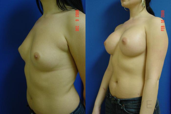Before & After Breast Augmentation Case 20 View #2 View in San Jose, CA
