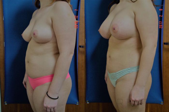 Before & After Liposuction Case 207 View #2 View in San Jose, CA