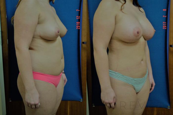 Before & After Breast Augmentation Case 207 View #3 View in San Jose, CA