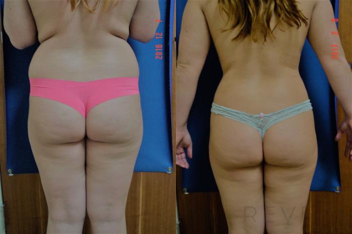 Before & After Breast Augmentation Case 207 View #4 View in San Jose, CA