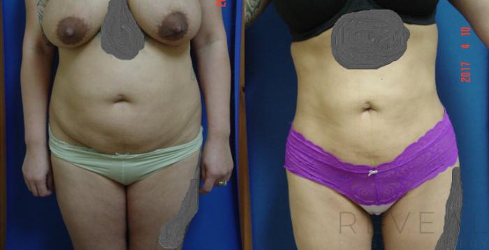 Before & After Liposuction Case 211 View #1 View in San Jose, CA