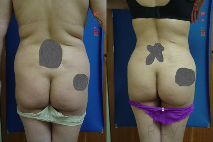 Before & After Brazilian Butt Lift Case 211 View #2 View in San Jose, CA